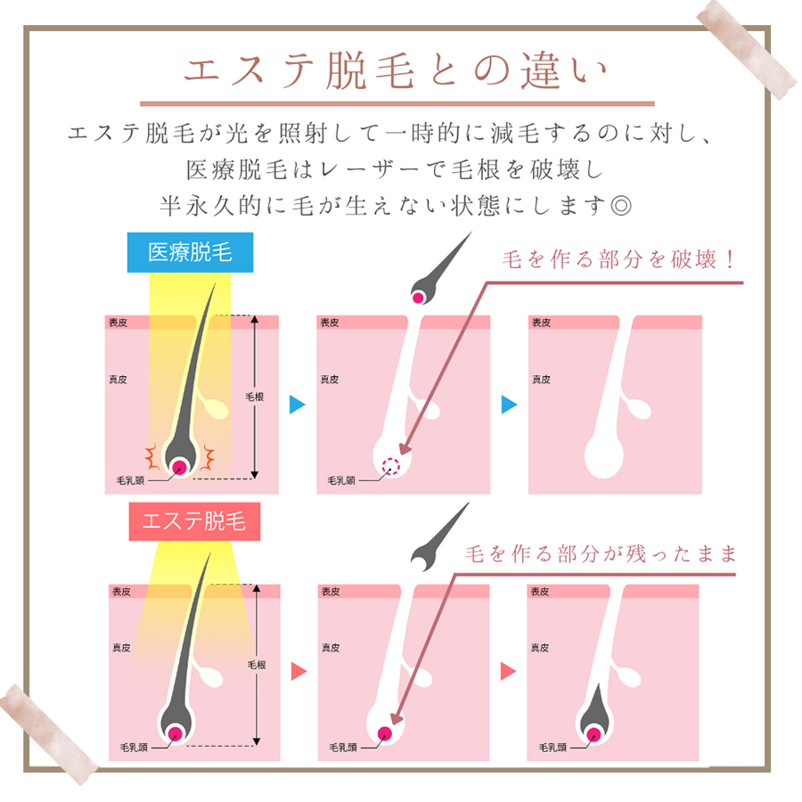 エステ脱毛との違い